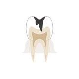 象牙質内の虫歯
