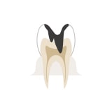 歯髄（歯の神経）におよぶ虫歯