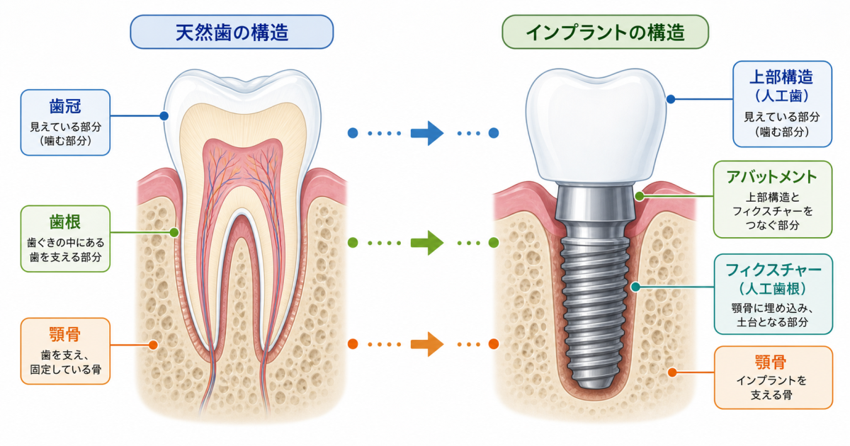■そもそもインプラントとは?天然歯との比較でわかる基本の仕組み