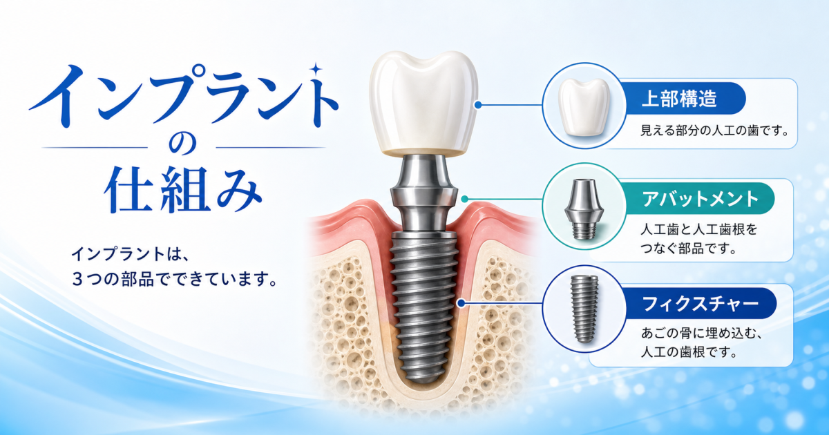 インプラントの仕組みとは？　フィクスチャーから人工歯まで構造の全体像
